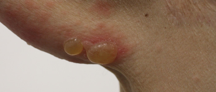 enfermedad_ampollosa